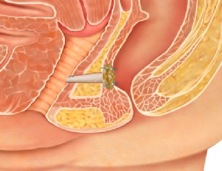 Advancement anal flap Facial bloating detox